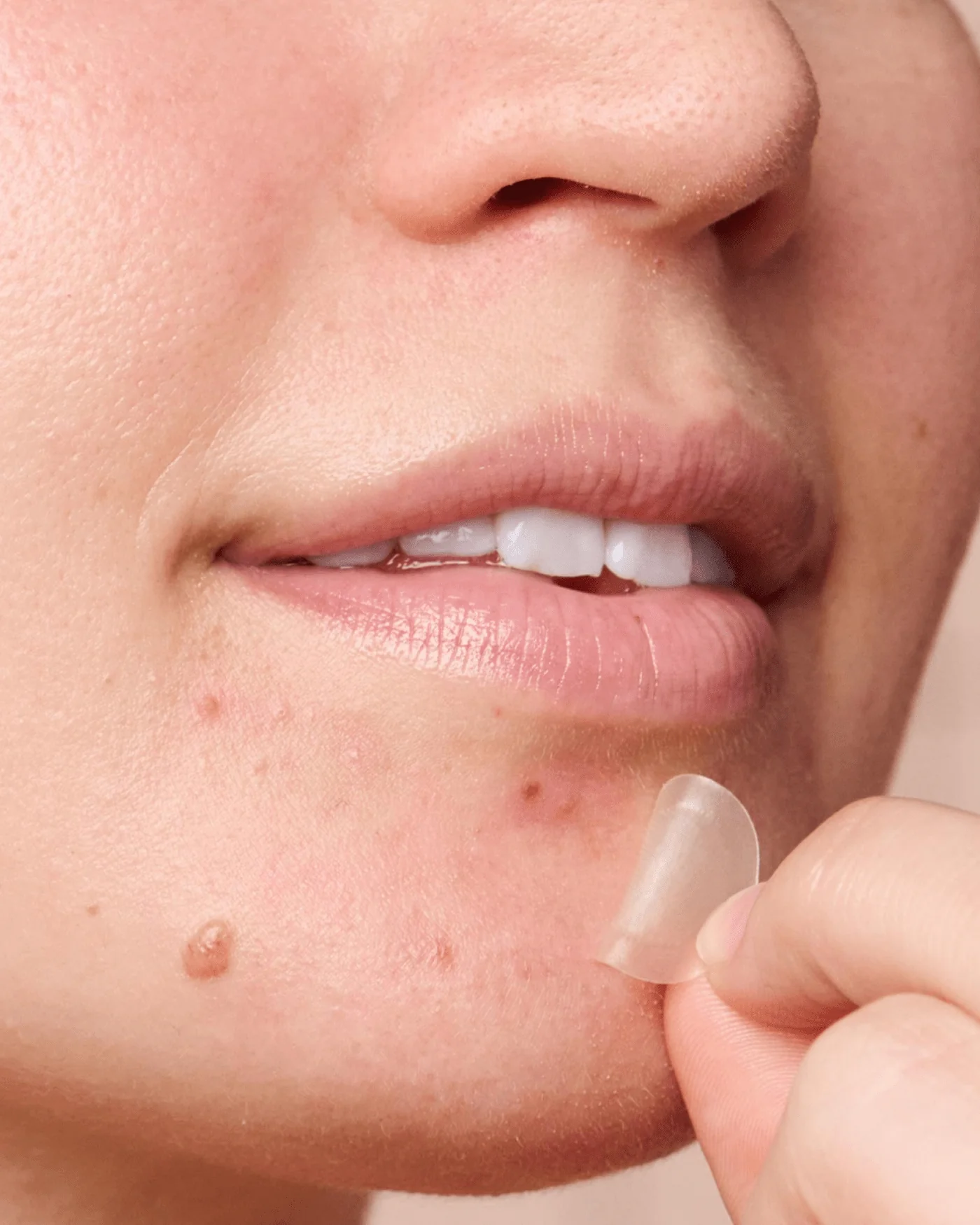 Might Patch - Micropoint for Blemishes - Image 7