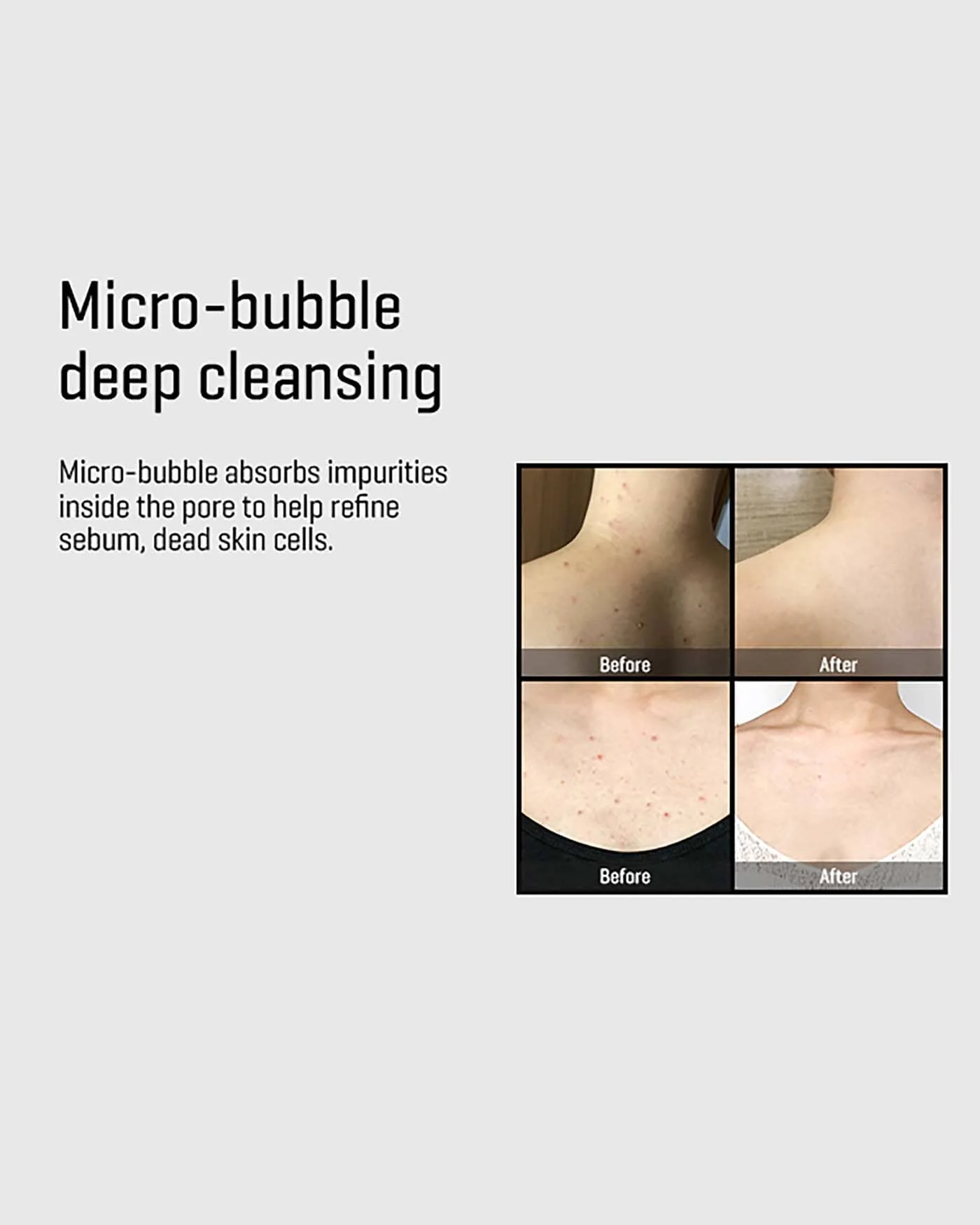 AHA-BHA-PHA 30 Days Miracle Acne Clear Body Cleanser - Image 5